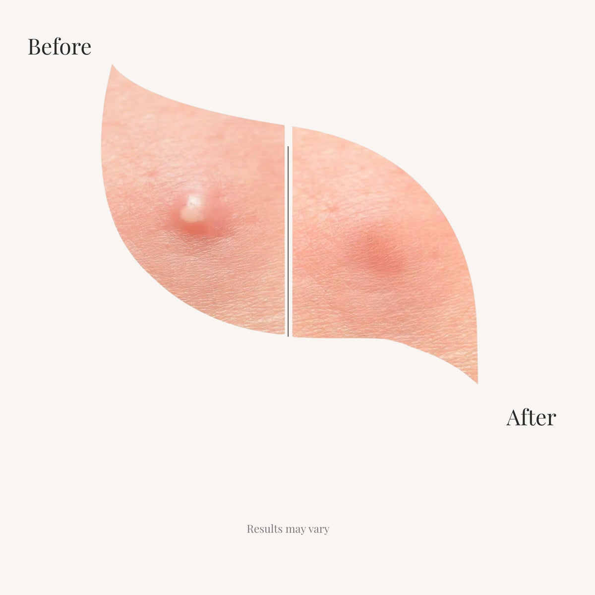Ghost Veil Invisible Acne Patches